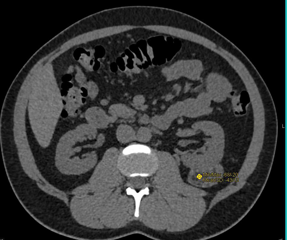 Renal Angiomyolipoma - Kidney Case Studies - CTisus CT Scanning