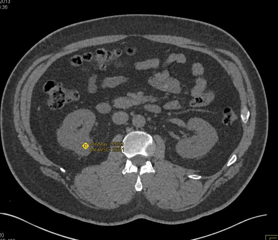 Multiphase Demonstration of a Clear Cell Renal Cell Carcinoma - CTisus CT Scan