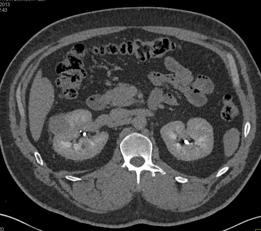 Multiphase Demonstration of a Clear Cell Renal Cell Carcinoma - CTisus CT Scan