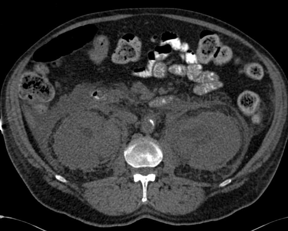 Perirenal Infiltration in Erdheim-Chester Disease - CTisus CT Scan