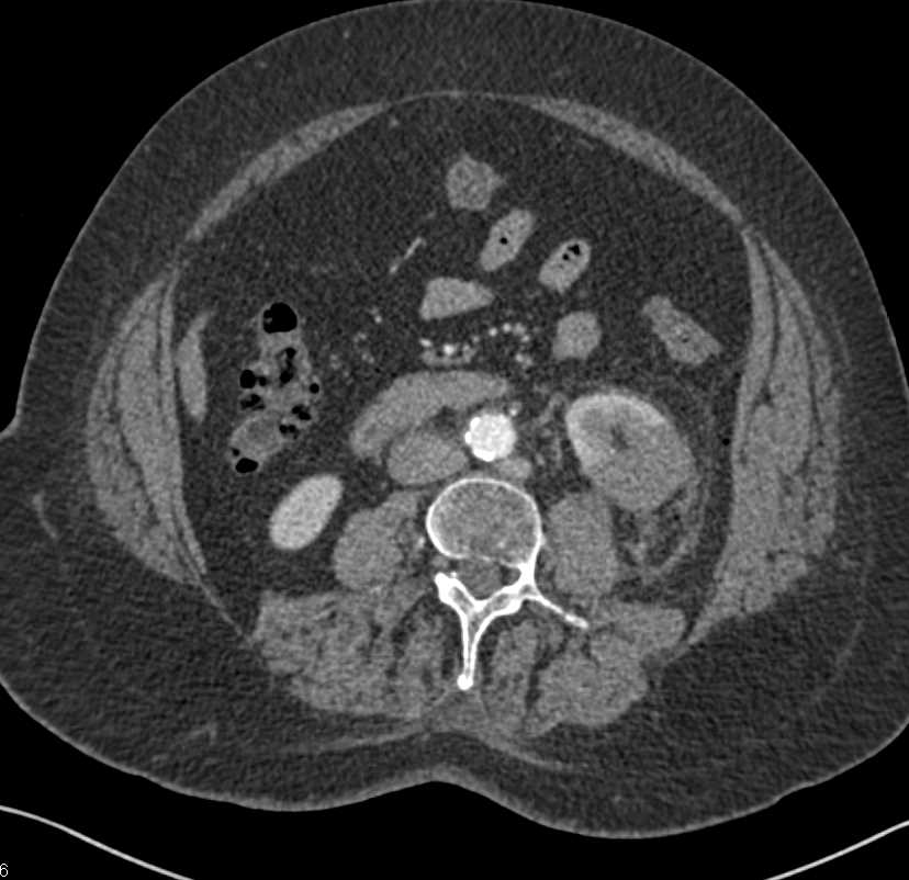 Post Ablation Changes Left Kidney - CTisus CT Scan