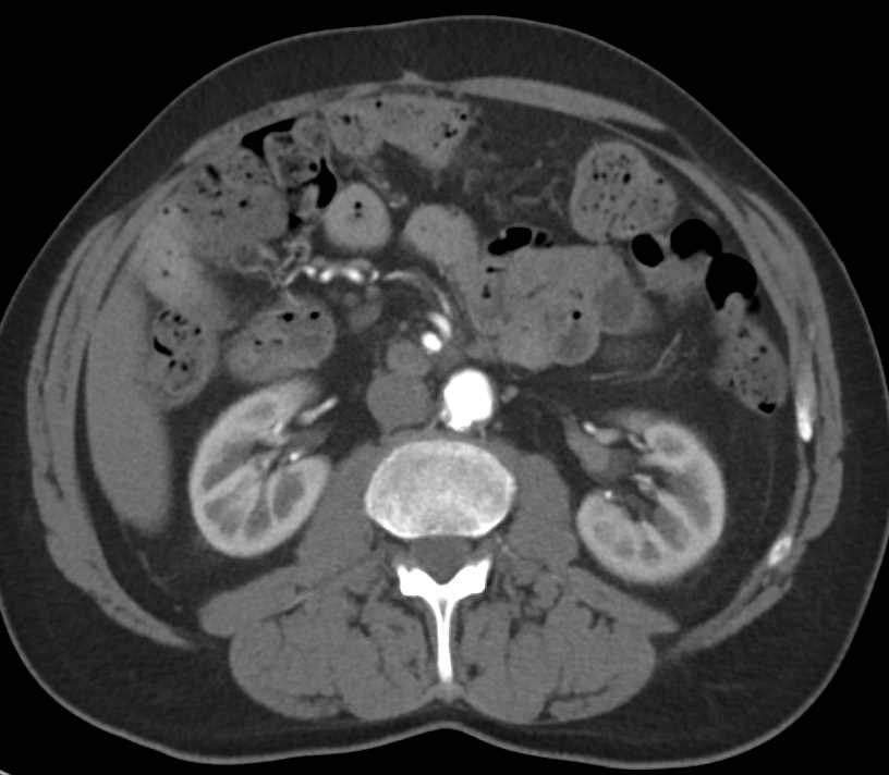 Transitional Cell Carcinoma Left Renal Pelvis - CTisus CT Scan