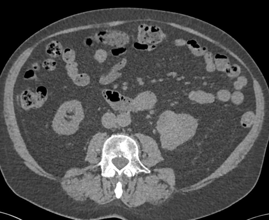 Transitional Cell Carcinoma Left Renal Pelvis with Left Renal Vein Involvement - CTisus CT Scan