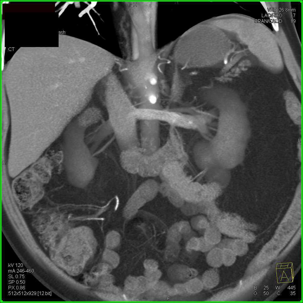 Transitional Cell Carcinoma Left Renal Pelvis with Left Renal Vein Involvement - CTisus CT Scan