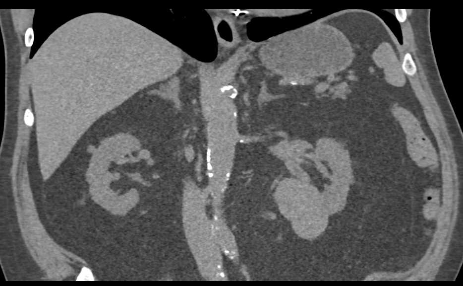 Papillary Renal Cell Carcinoma - CTisus CT Scan