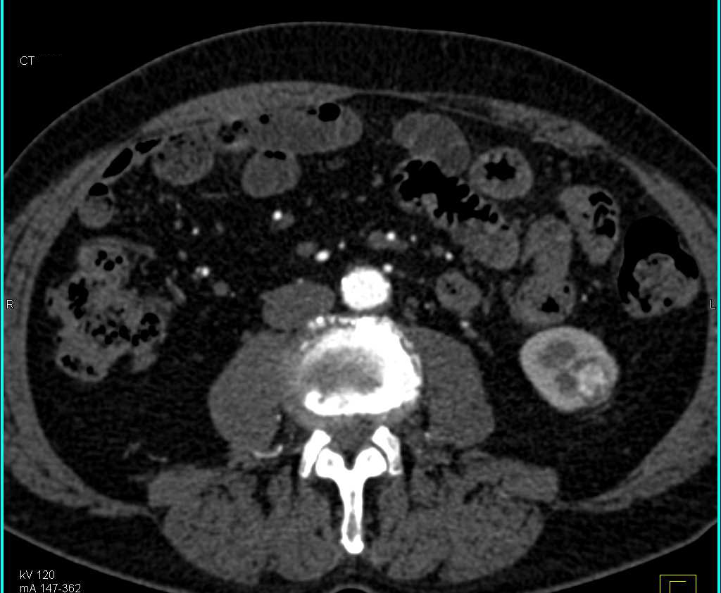 1 cm Left Renal Cell Carcinoma - CTisus CT Scan