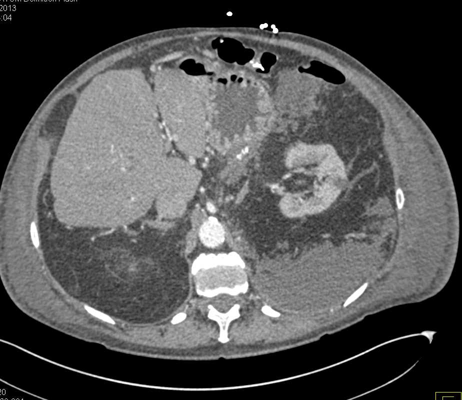 Large Left Perirenal Fluid Collection displaces Left Kidney - CTisus CT Scan