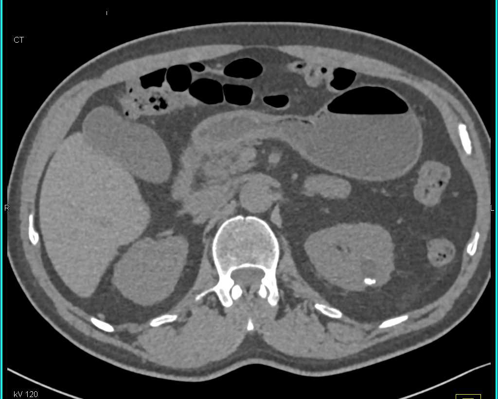 Calcifications in a Calyceal Diverticulum - CTisus CT Scan