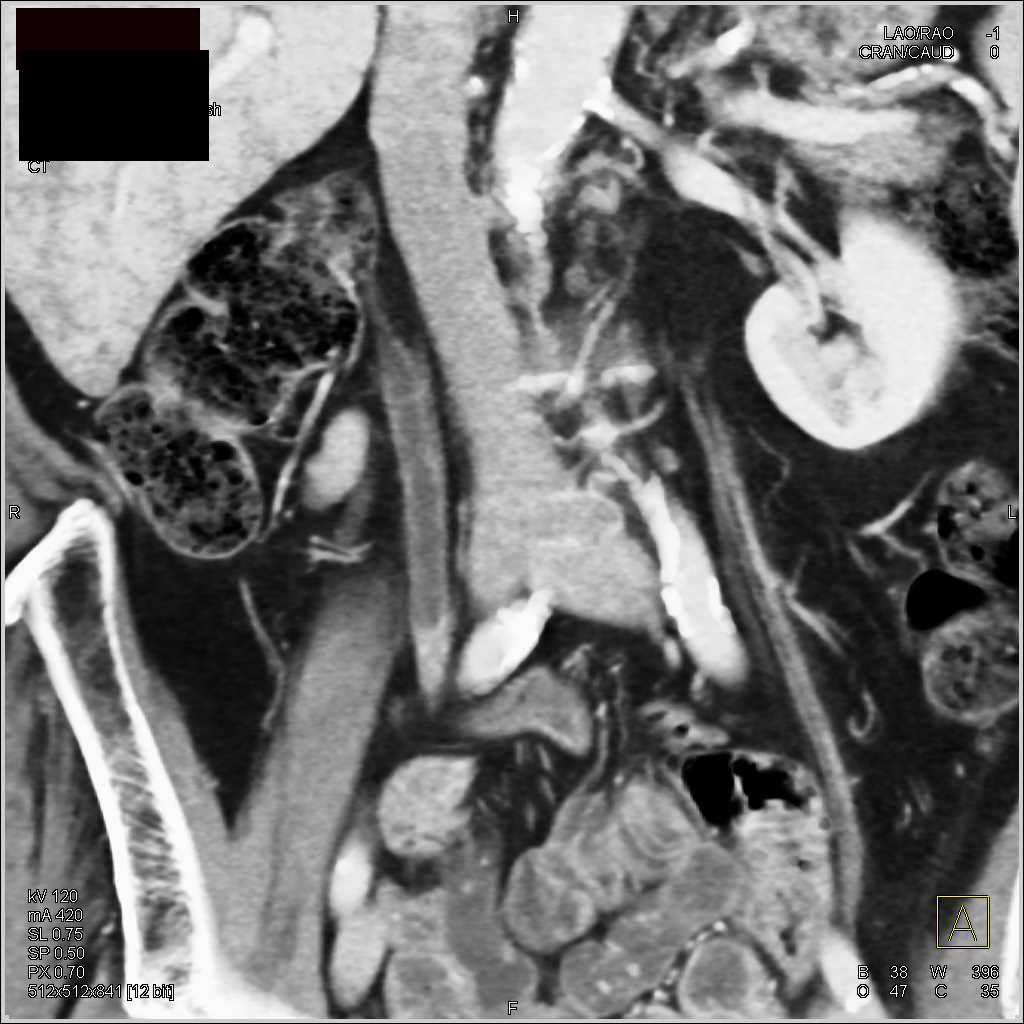 Subtle Transitional Cell Carcinoma Right Ureter - CTisus CT Scan