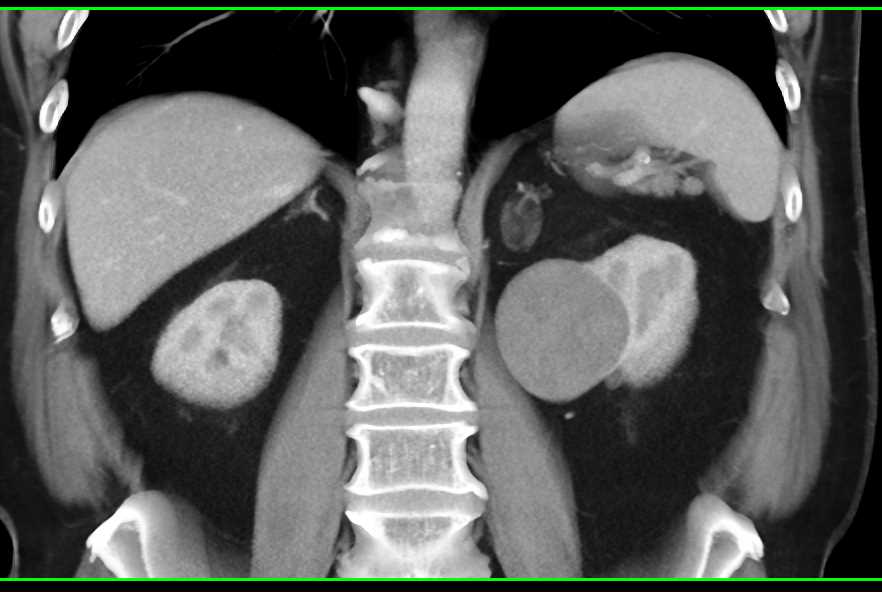 Complex Bosniak 2F Cyst - CTisus CT Scan