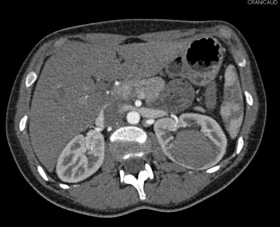 Complex Renal Cyst with Hemorrhage - CTisus CT Scan