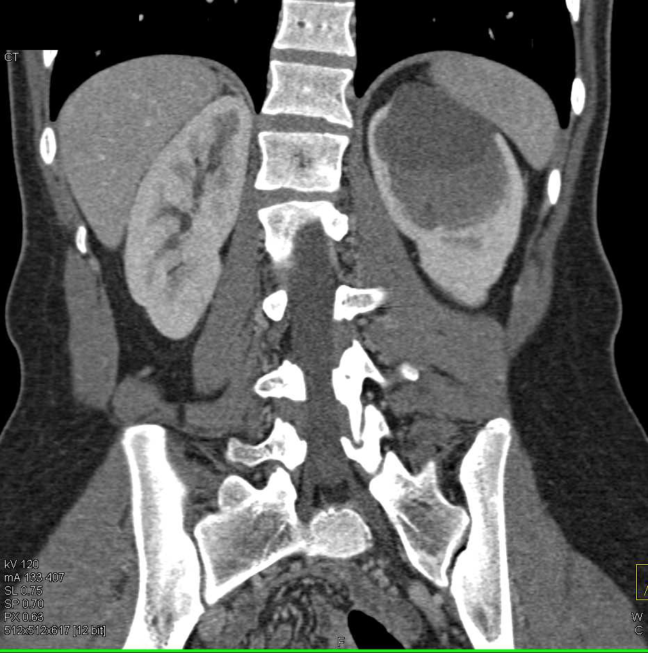 Complex Renal Cyst with Hemorrhage - Kidney Case Studies - CTisus CT ...