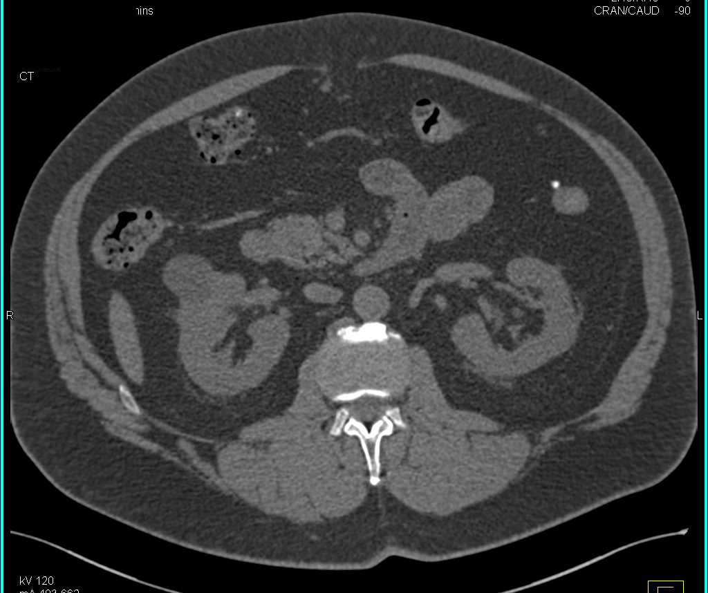 Bosniak 1 Cyst - CTisus CT Scan