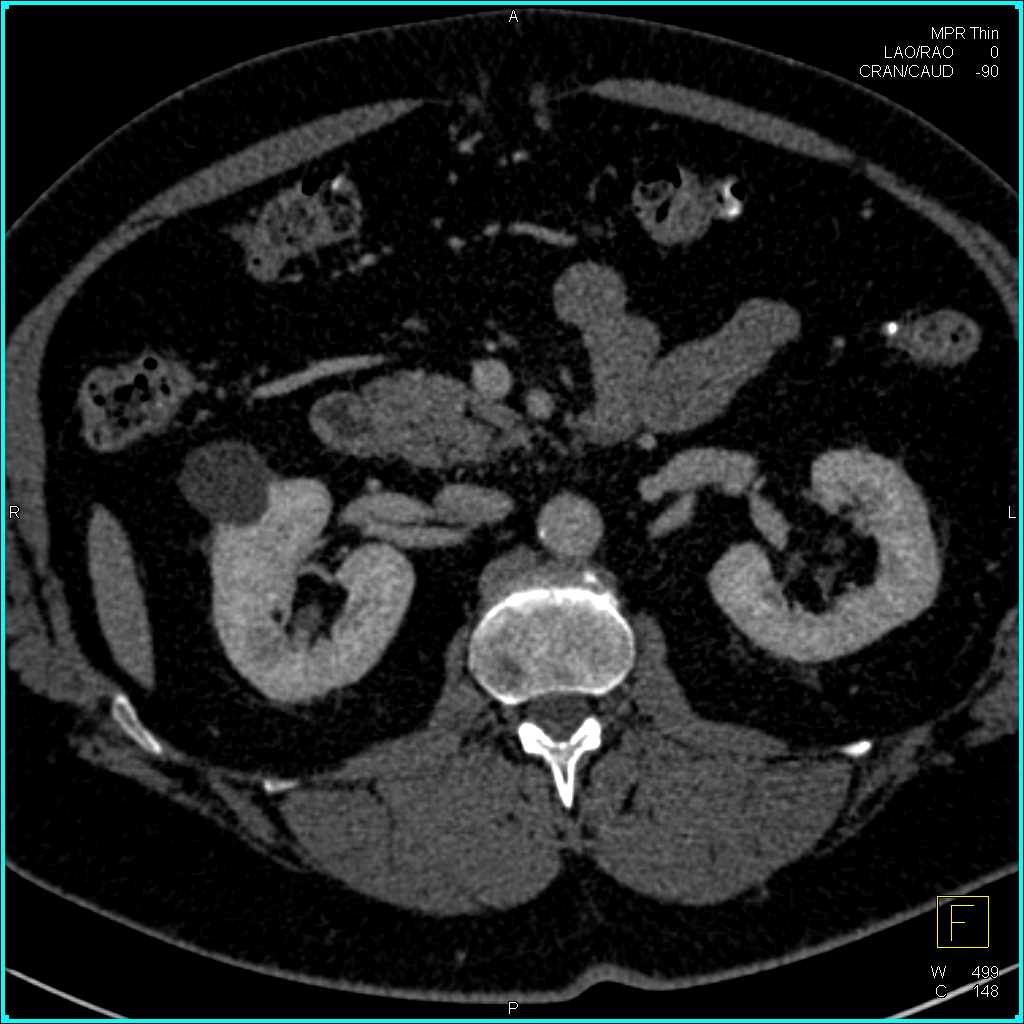 Subtle 1cm Right Renal Cell Carcinoma Best Seen on the 3D Image - CTisus CT Scan