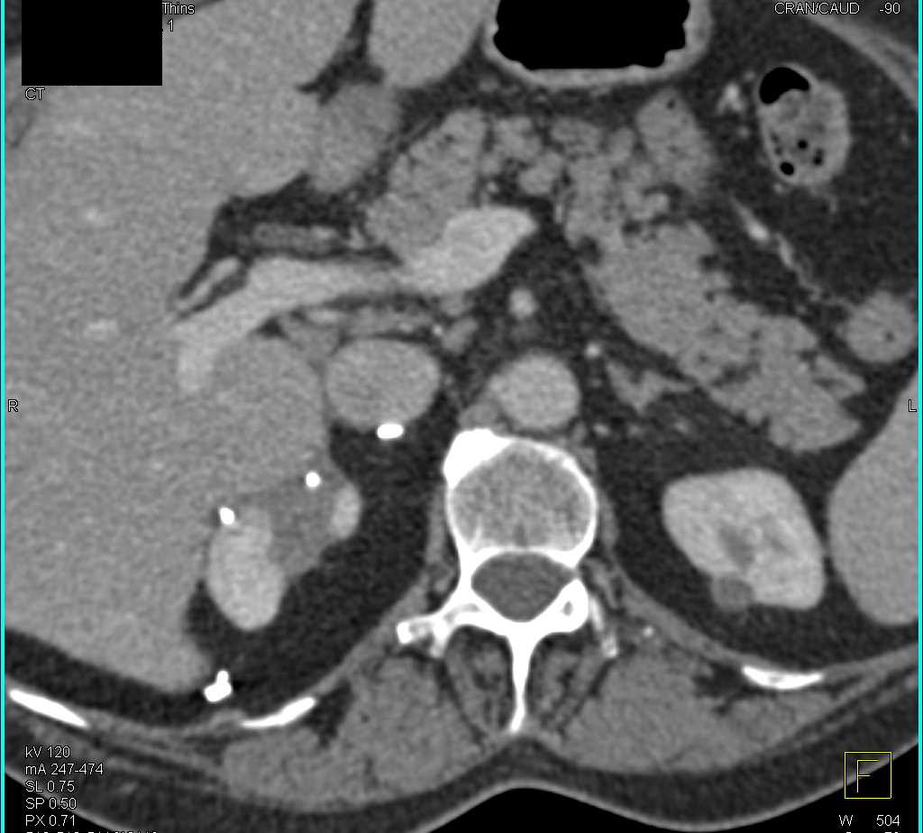 Infarct Upper Pole Right Kidney - CTisus CT Scan