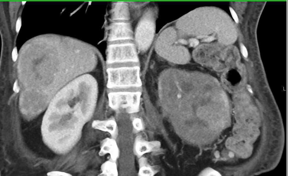 Infiltrating Renal Cell carcinoma Invades the Left Renal Vein and the Inferior Vena Cava (IVC) with Liver Metastases - CTisus CT Scan