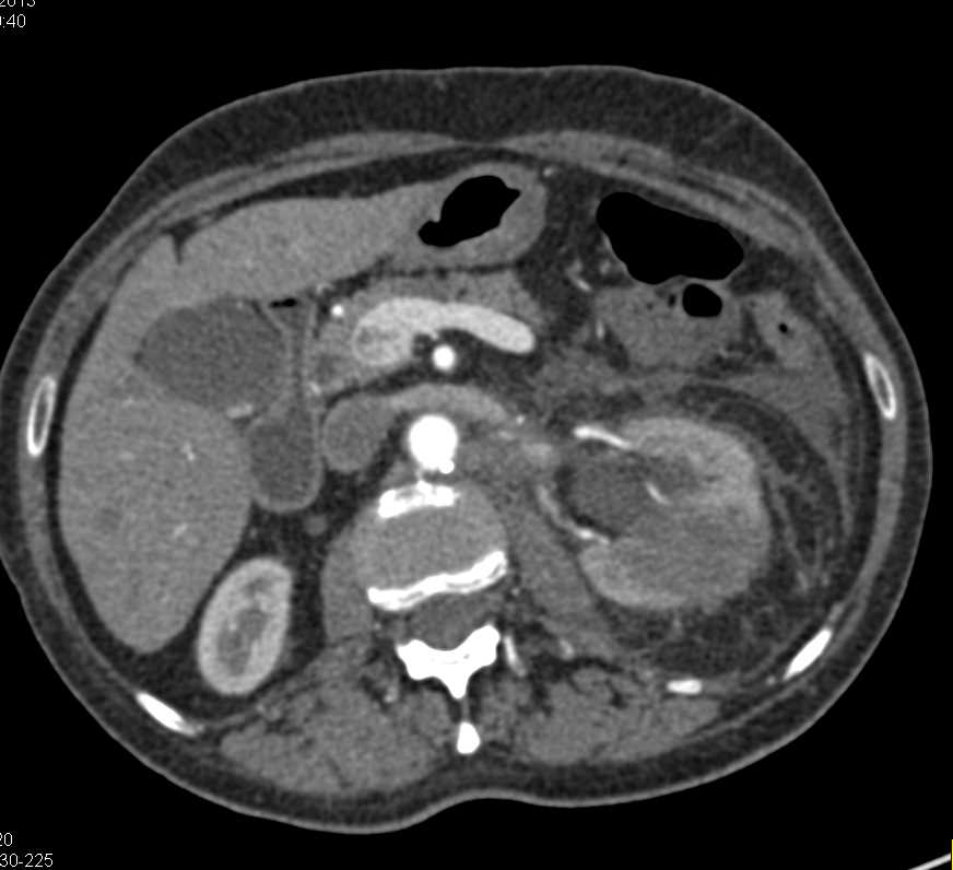 Carcinoma Distal Left Ureter with Left Hydropnephrosis and Inflammation - CTisus CT Scan