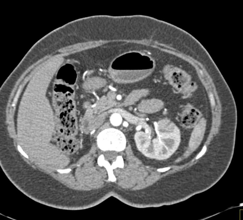 Right Nephrectomy with Metastases to the Left Kidney - CTisus CT Scan