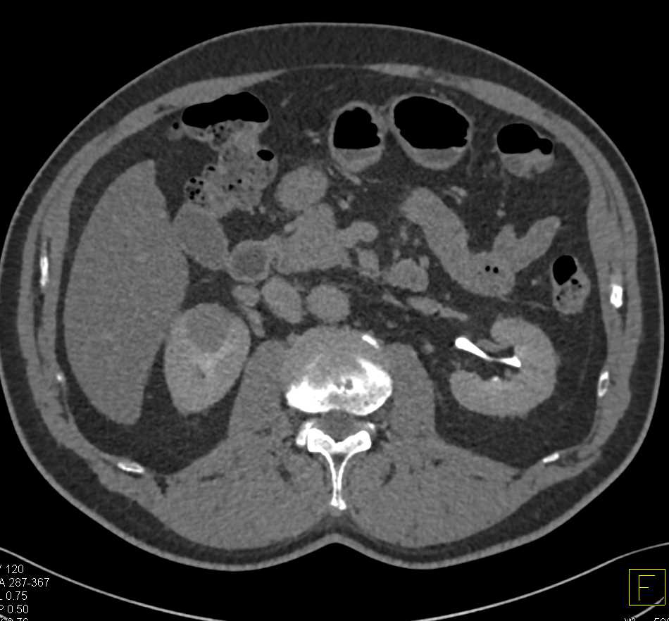 Papillary Renal Cell Carcinoma Right Kidney - CTisus CT Scan