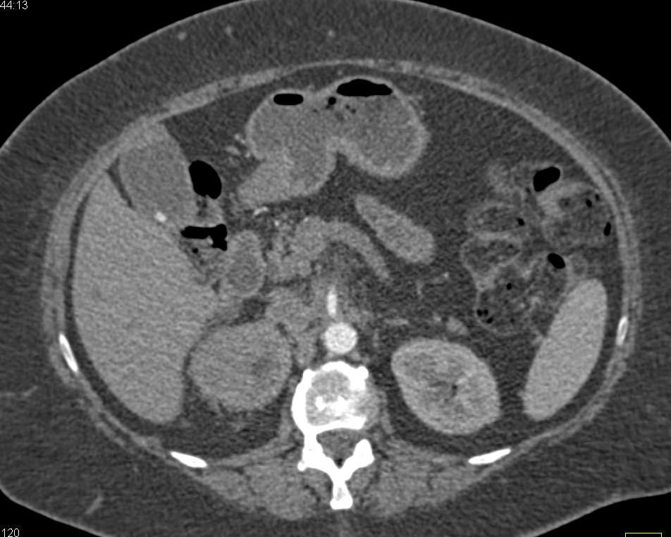 Renal Cell Carcinoma Right Kidney - CTisus CT Scan