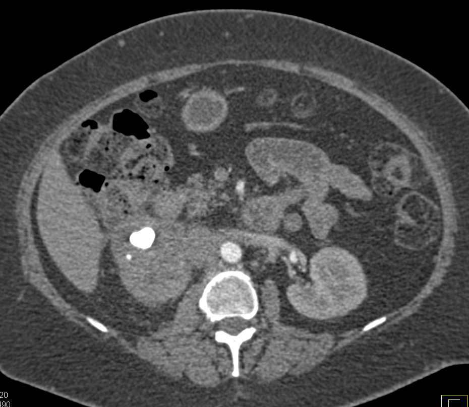 Renal Cell Carcinoma Right Kidney Looks Like Transitional Cell Cancer (TCC) or Xanthogranulomatous Pyelonephritis (XGP) - CTisus CT Scan