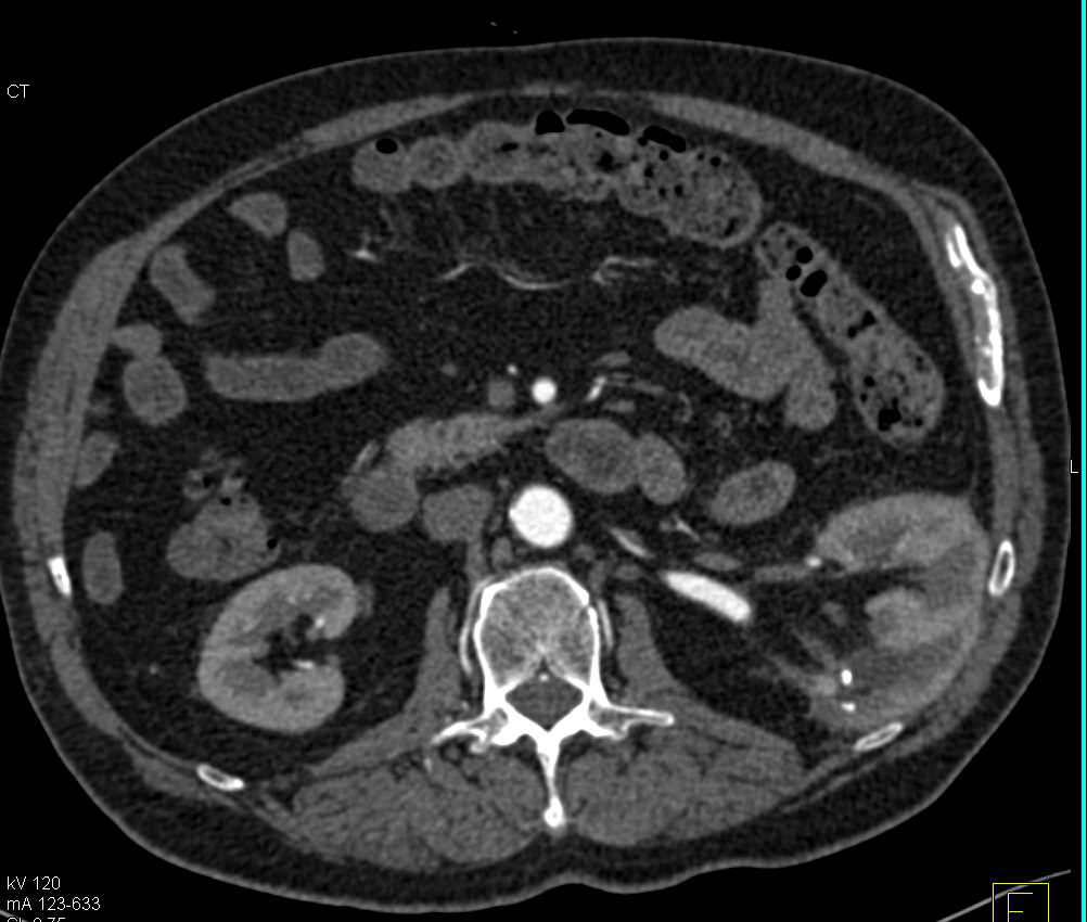 Left Kidney Positioned Posteriorly Because of Prior Nephrostomy Tube - CTisus CT Scan