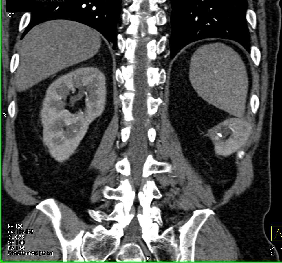 Left Kidney Positioned Posteriorly Because of Prior Nephrostomy Tube ...
