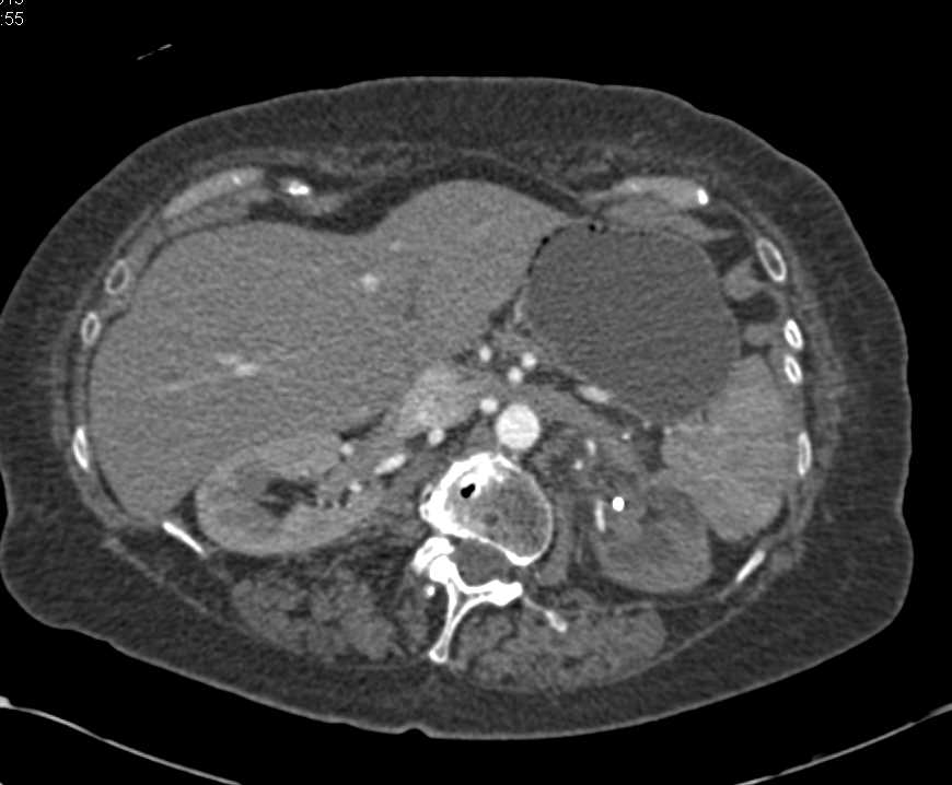 Transitional Cell Carcinoma Left Renal Pelvis - CTisus CT Scan