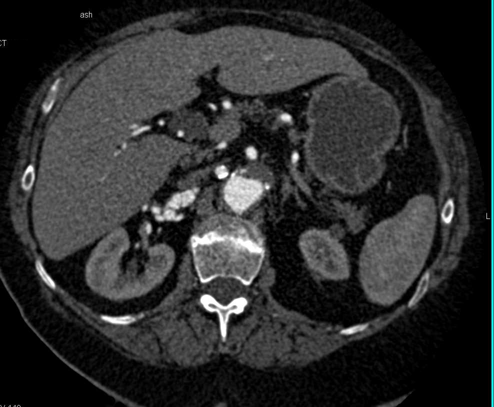 Fibromuscular Dysplasia (FMD) of the Right and Left Renal Artery - CTisus CT Scan