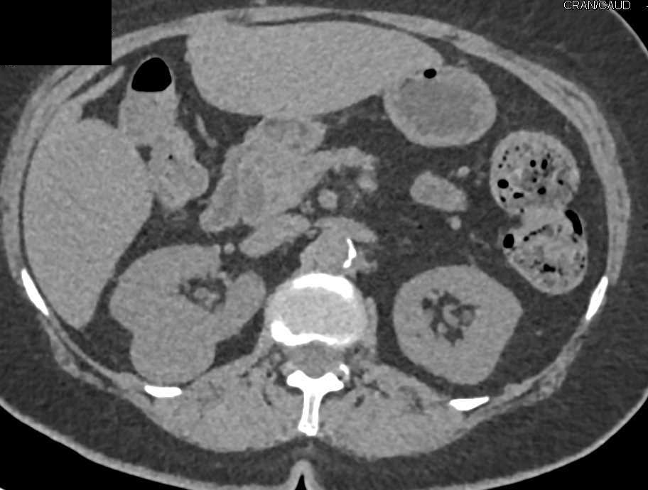 Papillary Renal Cell Carcinoma Right Kidney - CTisus CT Scan