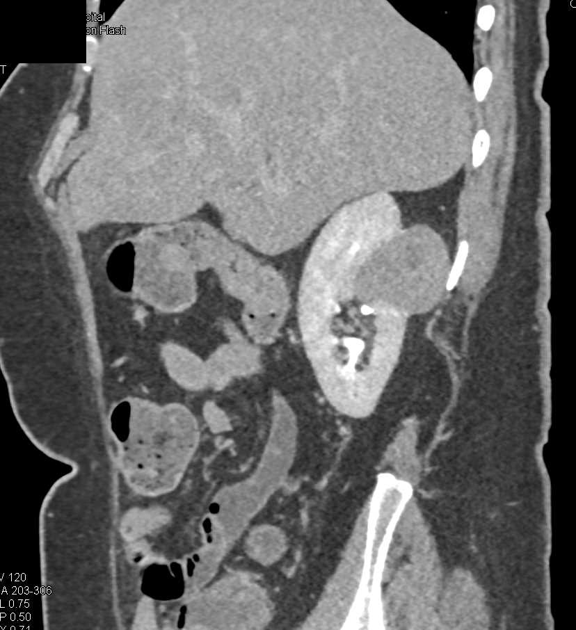 Papillary Renal Cell Carcinoma Right Kidney - CTisus CT Scan