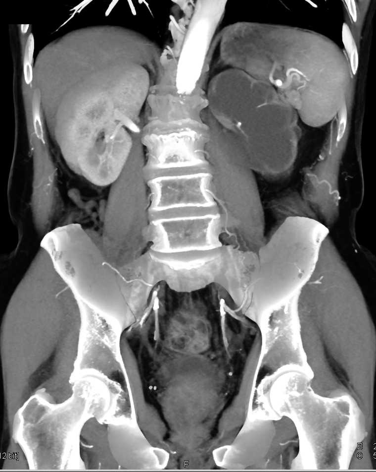 Hydronephrosis Left Kidney with Patent Renal Arteries - CTisus CT Scan