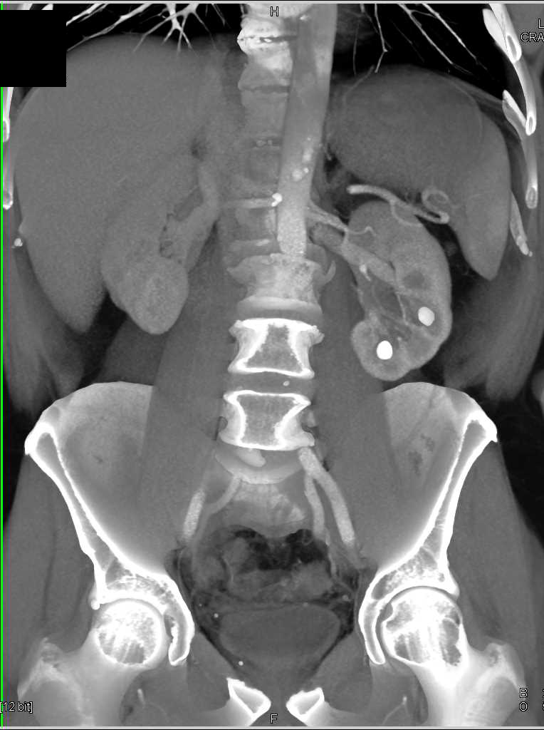 Bilateral Renal Calculi - CTisus CT Scan