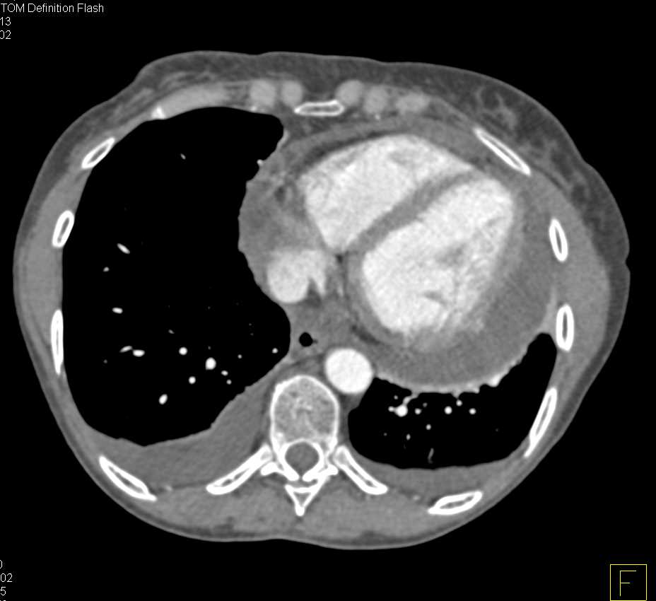 Pericardial Effusion in a Patient with a Transplant Kidney - CTisus CT Scan