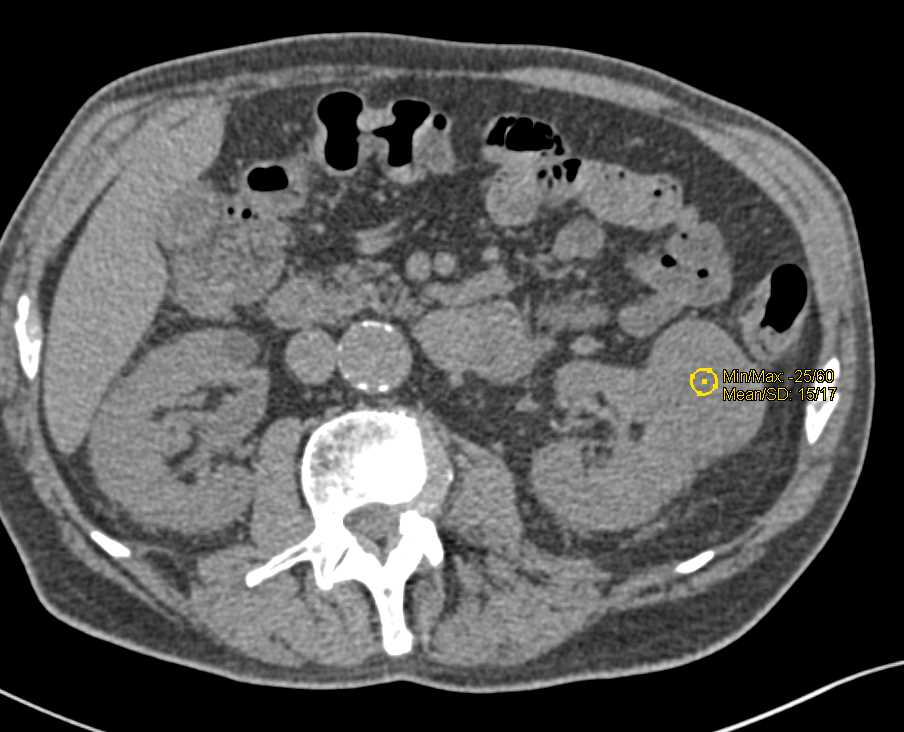 High Density Left Renal Cyst Simulates a Tumor - CTisus CT Scan