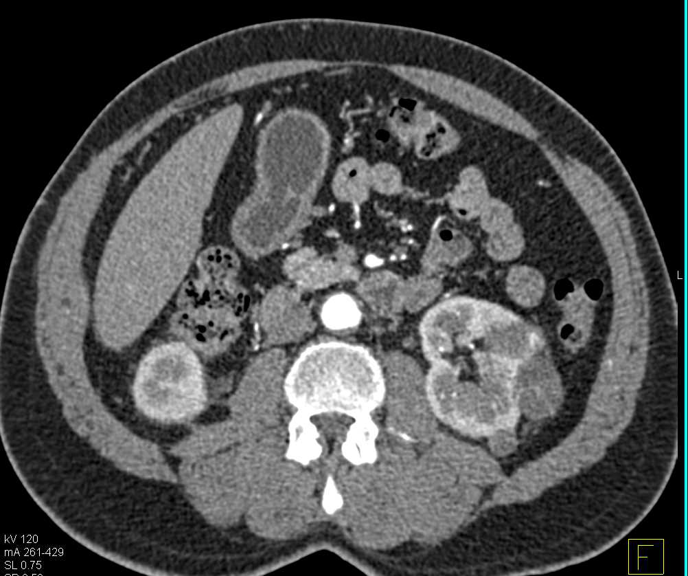 Bilateral Renal Cell Carcinomas - CTisus CT Scan