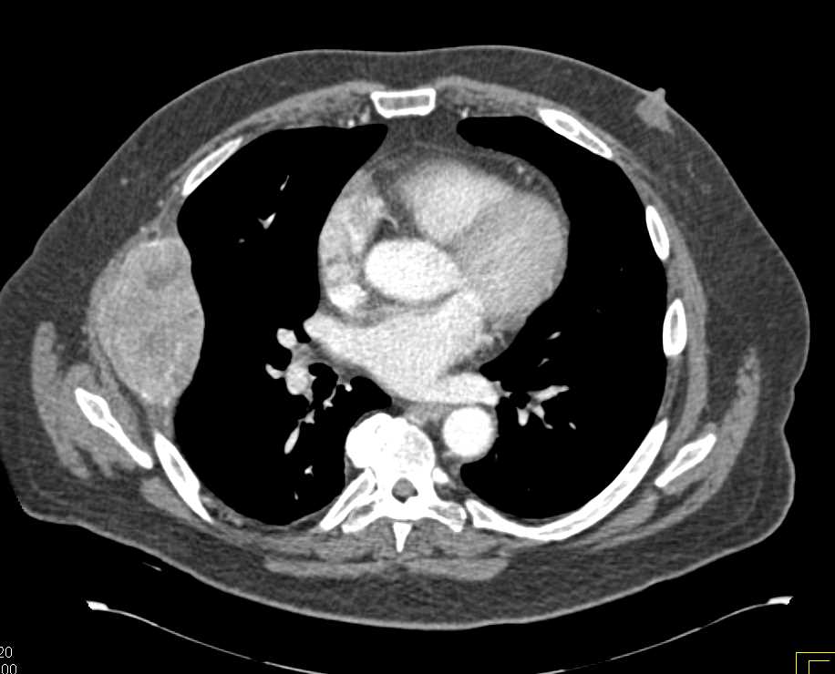 Metastatic Renal Cell Carcinoma with Rib Metastases - CTisus CT Scan