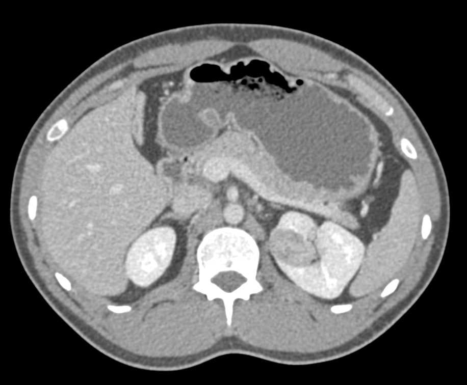 Papillary Renal Cell Carcinoma Left  Kidney - CTisus CT Scan