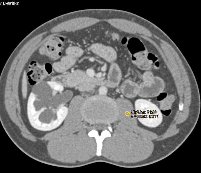 Papillary Renal Cell Carcinoma Left  Kidney and Stone Distal Right Ureter with Obstruction - CTisus CT Scan