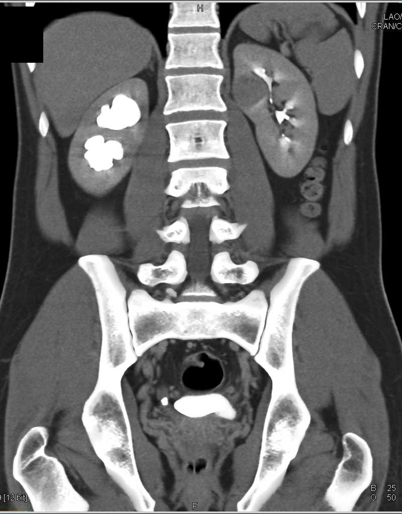 Papillary Renal Cell Carcinoma Left  Kidney and Stone Distal Right Ureter with Obstruction - CTisus CT Scan