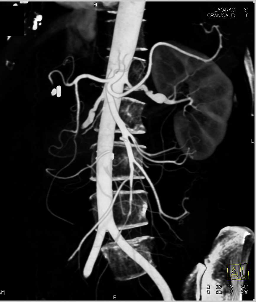 Left Renal Artery Aneurysm - CTisus CT Scan