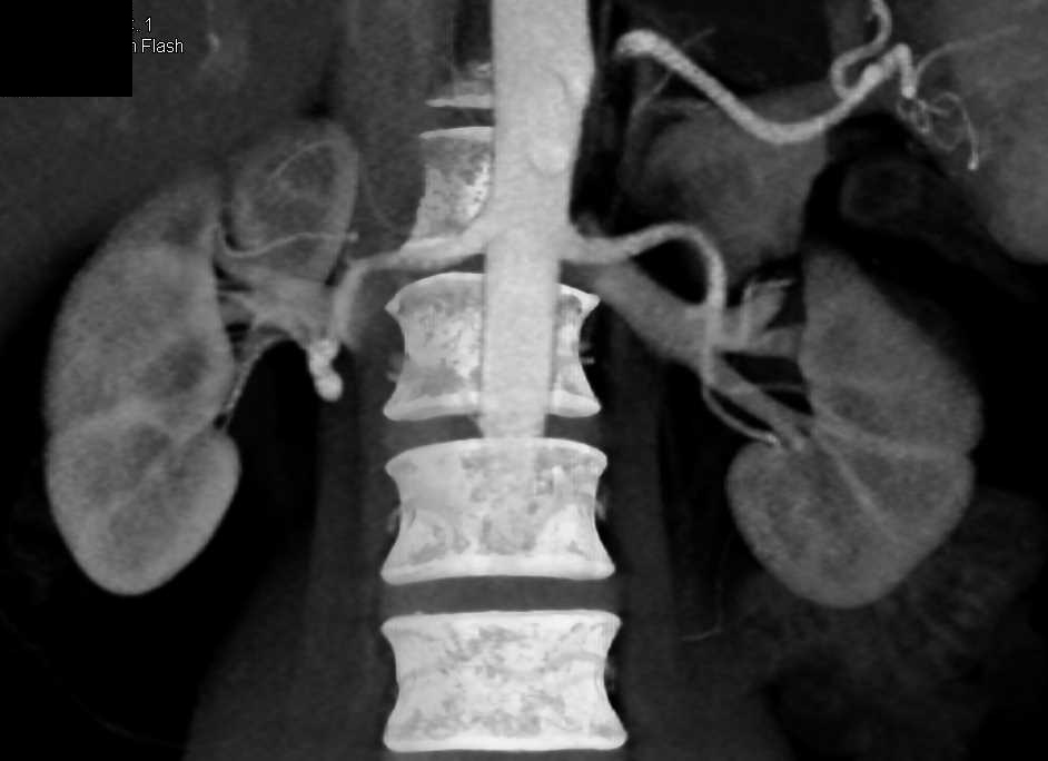 Right Renal Artery Aneurysm - CTisus CT Scan