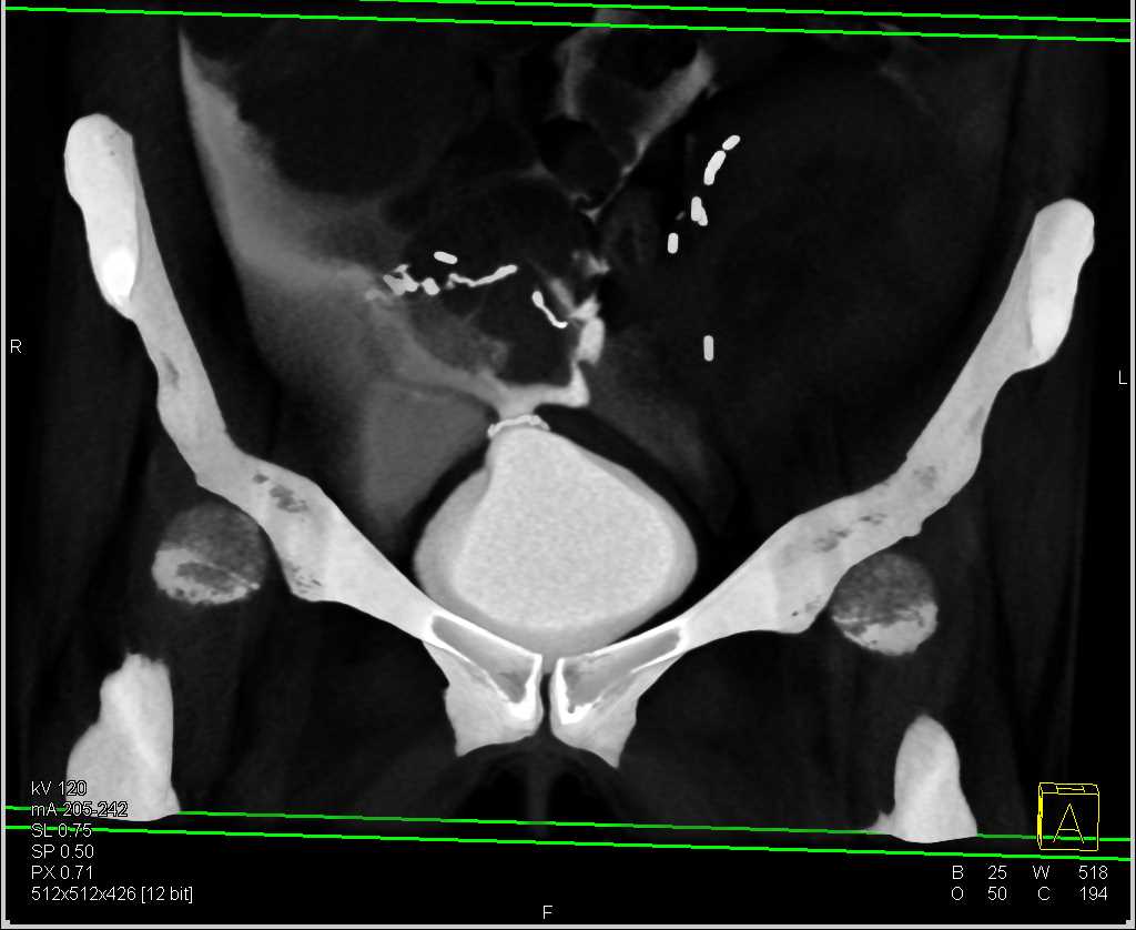 CT Cystogram with Leak Following Renal Transplant. Leak is Large - CTisus CT Scan