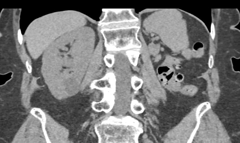 Metastases to the Contralateral Kidney from Renal Cell Carcinoma - CTisus CT Scan