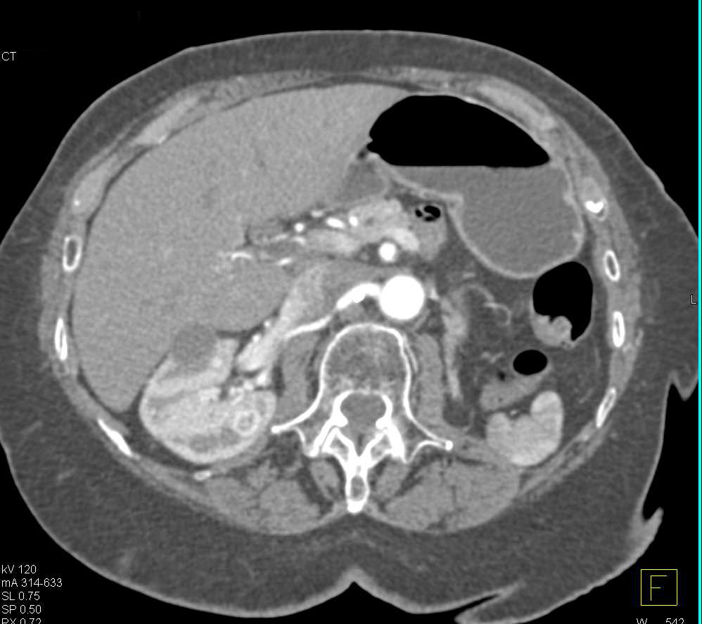 Metastases to the Contralateral Kidney from Renal Cell Carcinoma are Best Seen on the MIP Images - CTisus CT Scan