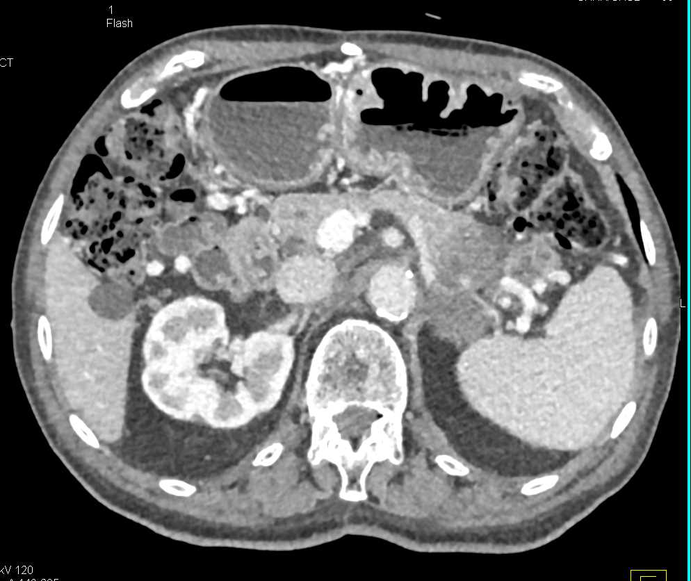 Metastases to the Pancreas from Renal Cell Carcinoma - CTisus CT Scan