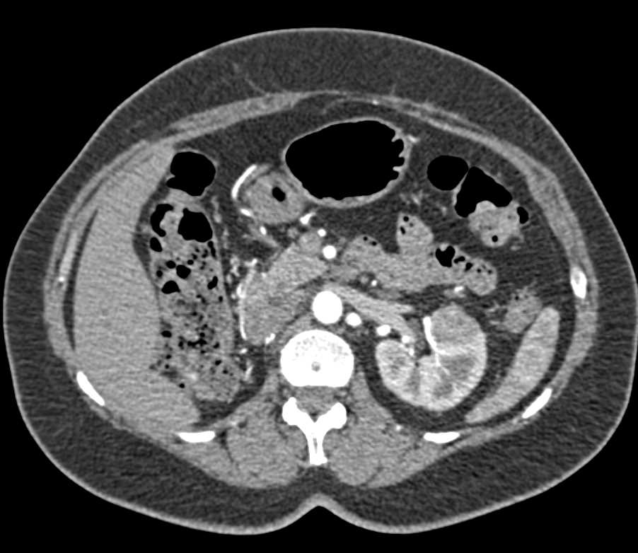 Right Nephrectomy with Recurrence in the Contralateral Kidney - CTisus CT Scan