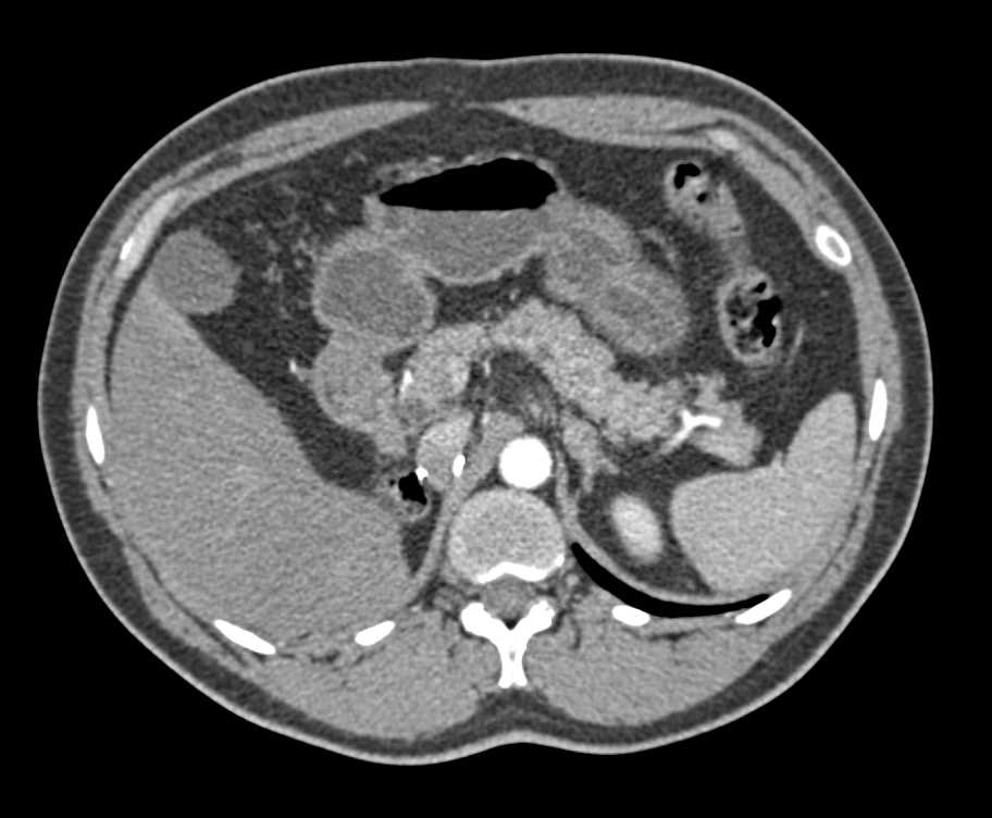 Enlarged Nodes in Nephrectomy Bed - CTisus CT Scan