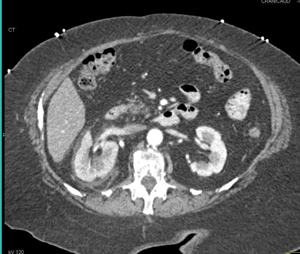 Obstructed Right Kidney with Stone in Proximal Right Ureter - CTisus CT Scan