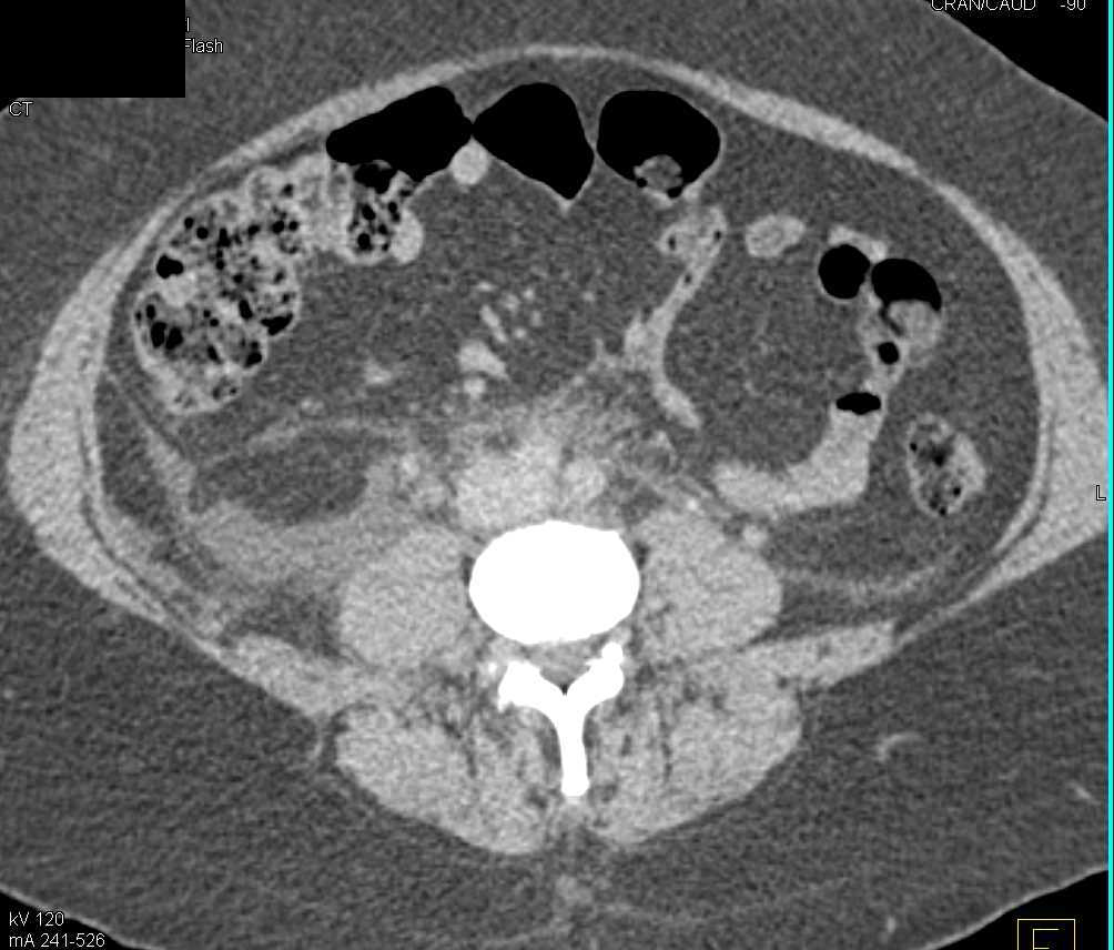 Fluid Tracts RLQ due to Obstruction Ureter due to A Stone - CTisus CT Scan